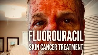 Fluorouracil Skin Treatment  Before During and After [upl. by Nyliac]