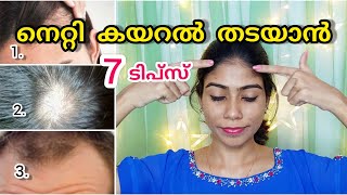 🌸😯നിങ്ങളുടെ മുടി കൊഴിയുന്നത് ഇങ്ങനെ ആണോHow to get rid of forehead hairfall at homeMalayalamNerin [upl. by Bithia90]