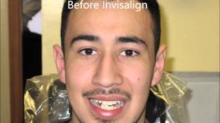 Invisalign before and after testimonial [upl. by Drofnelg287]