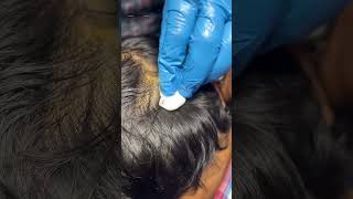 Scalp Care Cyst Removal Healthy Scalp Skin Care Skin Specialist in Jaipur Radiant Skin Clinic [upl. by Yrekcaz]