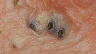 old blackheads extraction compilation [upl. by Adihaj]