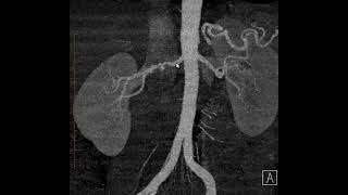 Displasia fibromuscular da artéria renal [upl. by Llereg]