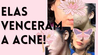 COMO 4 Mulheres Acabaram com a ACNE ⚡ Usando o que aprenderam no canal  FOTOS antesampdepois [upl. by Mayhew]