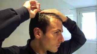 Tratamiento laser capilar domiciliario  Hair loss laser treatment home use [upl. by Nahtnoj901]