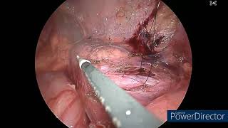 Laparoscopic ureteroureterostomy for mid ureteric obstruction [upl. by Luzader859]