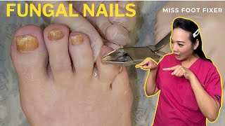 Complete Fungal Nail Treatment A StepByStep Guide  Miss Foot Fixer [upl. by Marybella]