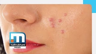 Pimples And Treatment  Doctor2PM Mathrubhumi News [upl. by Arraeit350]