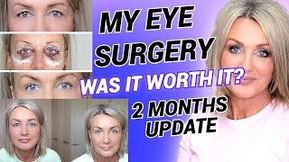 My Eyelid Surgery 2 months Update Was It Worth It eyelidsurgery blepharoplasty [upl. by Kora491]