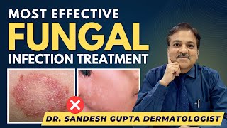 Effective Fungal Infection Treatment By Dermatologist  Dr SANDESH GUPTA 9990804089 [upl. by Guntar]