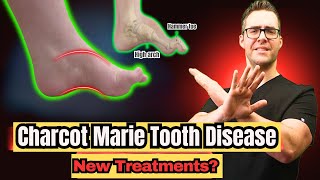 Charcot Marie Tooth Disease  Symptoms amp NEW Treatments 2024 [upl. by Glyn810]