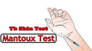 tb skin test  Mantoux test  tuberculin skin test [upl. by Rochella]