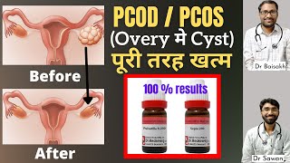 Best homeopathic medicine for PCODPCOS overy me cyst ka homeopathic ilaj [upl. by Airretal]