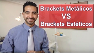 Brackets metálicos o estéticos ¿Cuál es mejorOrtodoncia en Querétaro [upl. by Denten874]