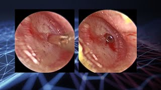 Endoscopic myringotomy and ventilation tube placement in glue ear [upl. by Stearne]