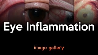 Eye Inflammation Image Gallery [upl. by Mehalek950]