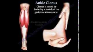 Ankle Clonus  Everything You Need To Know  Dr Nabil Ebraheim [upl. by Newkirk933]