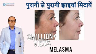 पुरानी से पुरानी झाइयां हटाए  Melasma  causes  precautions and treatment  Dark Spots [upl. by Adnalu]