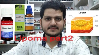 lipomaHomeopathic medicine for lipoma part 2 [upl. by Asante]