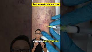 Escleroterapia 😱medicina medico enfermagem varizessemcirurgia varizes tratamento de varizes [upl. by Llerihs]