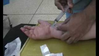 Carpal Tunnel Injection [upl. by Suryt]