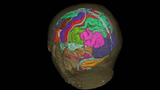 Cavernoma parietal [upl. by Tiernan]