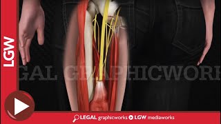 Hamstring Repair Surgery 3D animation [upl. by Lipson]