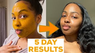 I DID A 5 DAY TURMERIC FACE MASK amp This Happened  MISS C Beauty [upl. by Sirama]