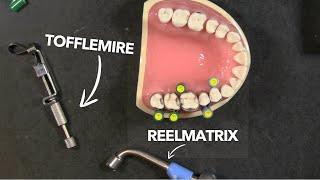 Comparing ReelMatrix to the Traditional Tofflemire [upl. by Judye]