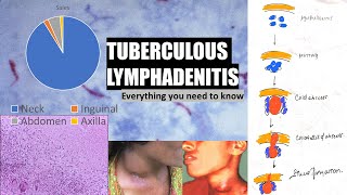 Tuberculous lymphadenitis  stages of cervical lymphadenitis  cold abscess  collar stud abscess [upl. by Browne]