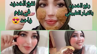 رفع الخدود بالفيلر الطبيعي، نفخ الخدود في يوم واحد 😍 قولي وداعا لنحافة الوجه [upl. by Noiwtna]