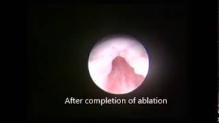 Posterior Urethral Valve Laser Ablation [upl. by Ardnael431]