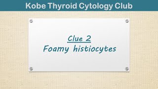 Diagnostic clues and pitfalls of thyroid FNA Clue 2 Foamy histiocytes [upl. by Irrak]