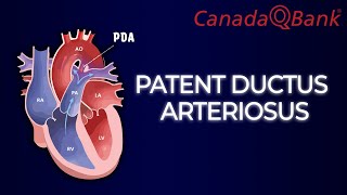 Patent Ductus Arteriosus [upl. by Enirehtak383]