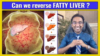 Fatty Liver  Do NOT Ignore  Dr Pal [upl. by Fahland177]