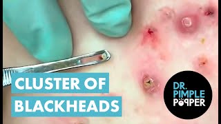 POPPING BLACKHEADS ON FACE NEWEST BLACKHEADS VIDEOS 2021 [upl. by Ytineres854]