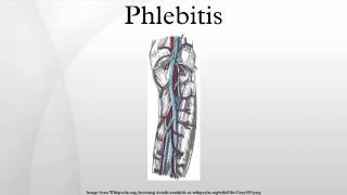 Phlebitis [upl. by Ardnaet995]