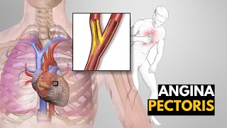 What is Angina Pectoris Causes signs and symptoms Diagnosis and treatment [upl. by Ierbua]