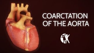 Coarctation of the Aorta [upl. by Eirffej418]