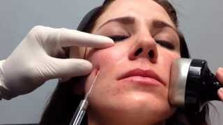 Voluma Quick Demonstration for Cheek Enhancement with Blunt Cannula Steve Weiner MD Destin [upl. by Pedaiah562]