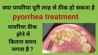 Pyrrohea treatmentक्या पायरिया पूरी तरह ठीक हो सकता हैपायरिया का इलाज tartar removalcalculus [upl. by Lladnyk963]