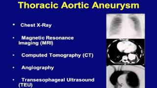 Minimally Invasive Repair of Thoracic Aortic Aneurysm Video  Brigham and Womens Hospital [upl. by Lyrred]