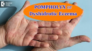 DYSHIDROTIC ECZEMA OR POMPHOLYX CausesSymptoms amp Treatment  Dr Aruna Prasad  Doctors Circle [upl. by Sher]