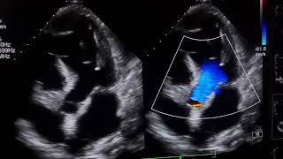 RWMAModerate LV DysfunctionTrace pericardial effusionpleural effusion cardioheartcondition [upl. by Demetra]