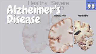 Alzheimers disease Pathophysiology Amyloid plaques and Tau tangles Risk Factors Treatment [upl. by Rebmyt285]