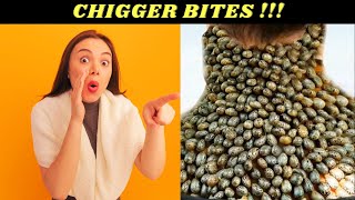 Chigger Bites Should You Worry And How Should You Treat Them [upl. by Kirkwood]