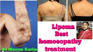 Lipoma homeopathy best medicine how to treatment lipoma without surgery [upl. by Morton]