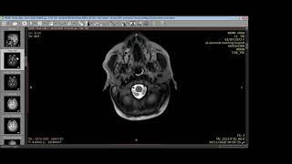 Oligodendroglioma [upl. by Anjali]