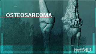 Basics Osteosarcoma  WebMD [upl. by Brenn]