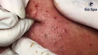 Blackheads 7750 [upl. by Roban751]