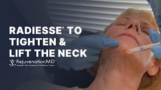 NonSurgical Neck Tightening  Hyperdilute Radiesse [upl. by Ayiram]